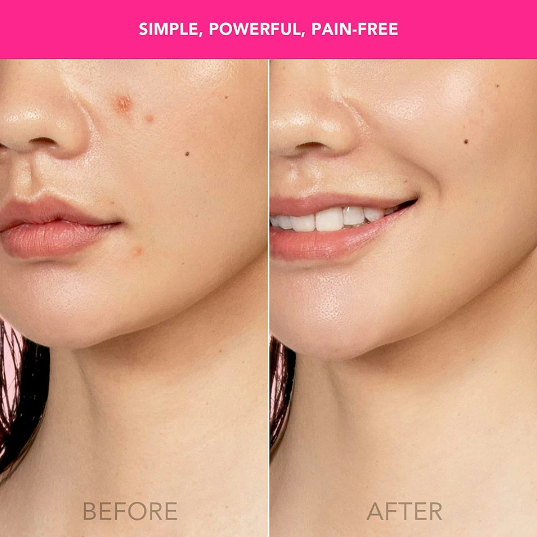 Foreo Espada Magenta - Acne Treatment Device